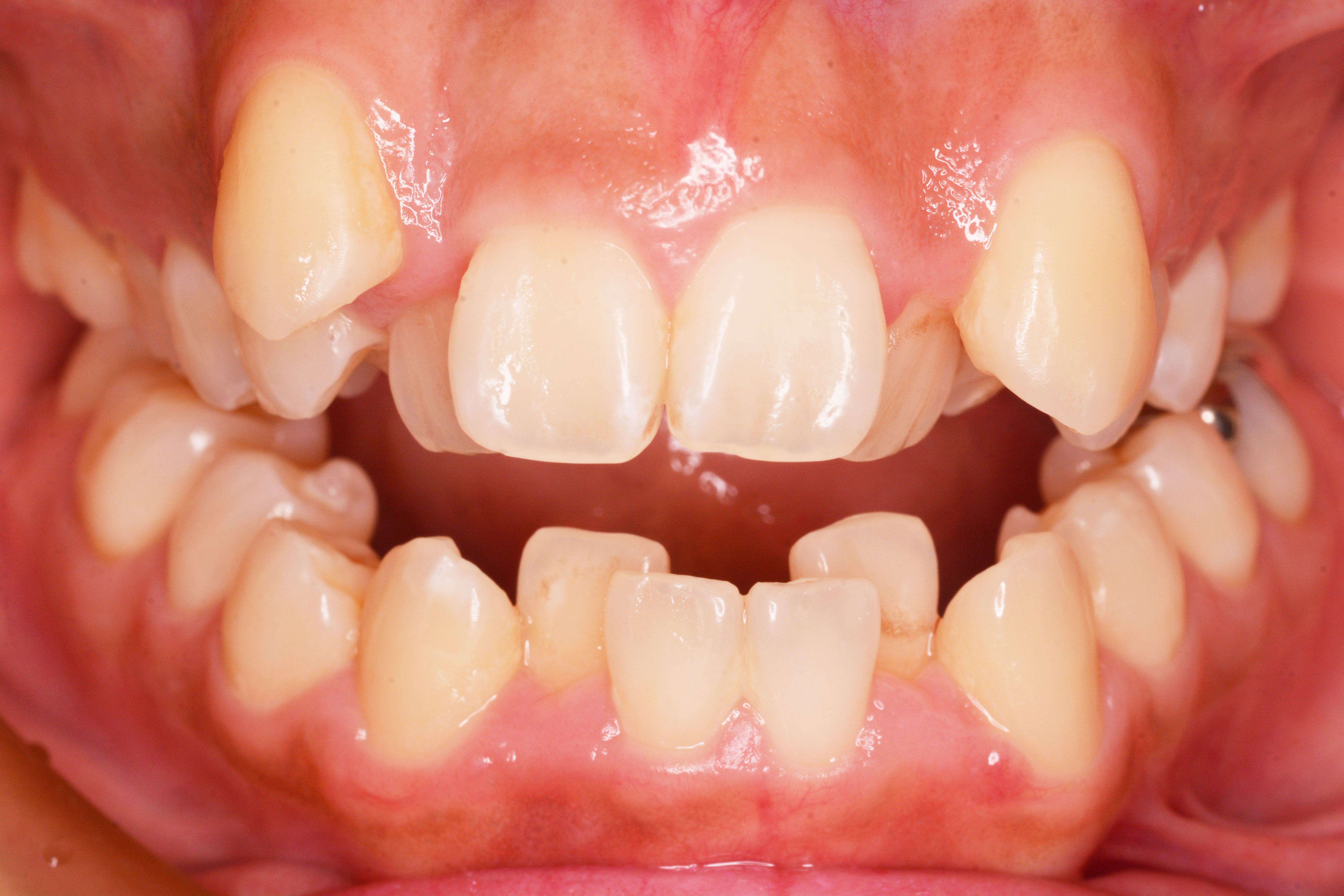福岡矯正歯科でのマウスピース矯正治療の流れとポイント