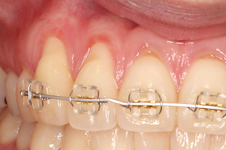 福岡矯正歯科が提供するマウスピース矯正と他院との違い