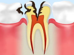 C3　神経のむし歯