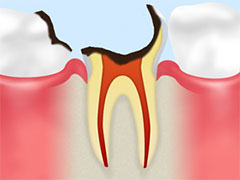 C4　歯根のむし歯