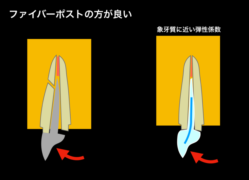 ファイバーポストと支台築造