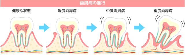 歯周病が気になる方へ天神の専門医